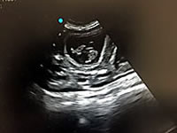 Pg ultrasound
